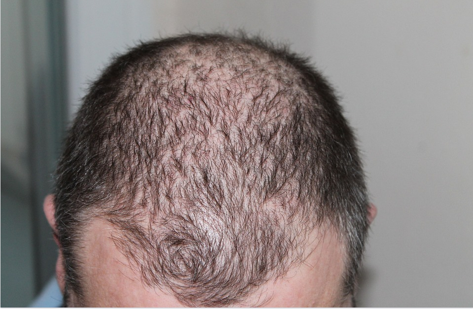 male head with hair loss